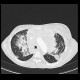 Melanoma of mediastinum: CT - Computed tomography